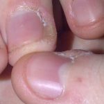 The Reasons of the Dry &Peeling Skin around the Fingernails