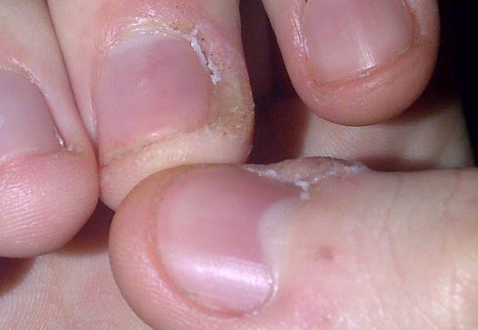 The Reasons of the Dry &Peeling Skin around the Fingernails -