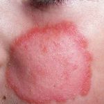 Use Tea Tree Oil and Get Rid Of Ringworm