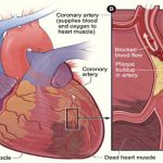 The Early Signs Of Heart Attack